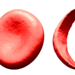 Sickle Cell Disease at a Glance